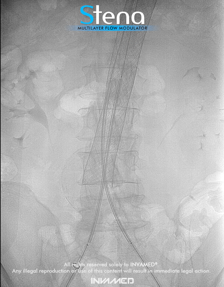 Aortic Aneurysms: Exploring the Stena Multilayer Flow Modulator